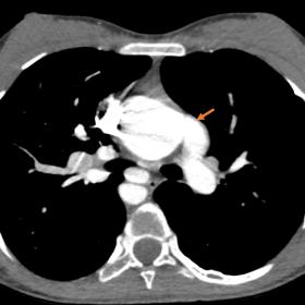 The left pulmonary artery (orange arrow) is arising from the ascending aorta with right sided aortic arch.