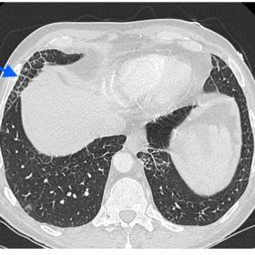 Axial chest CT showed bilateral and relatively symmetric interlobular septal thickening associated with small centrilobular n
