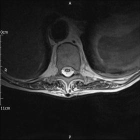 Select T2 weighted axial slice demonstrating the ‘Owl Eyes’ sign – hyperintense signal in the anterior spinal cord.