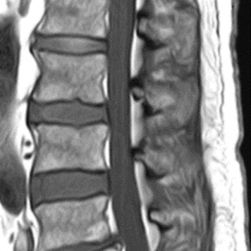 Non-contrast sagittal T1 spine image shows a modest increase in CSF signal and an enlarged conus medullaris (yellow arrow).