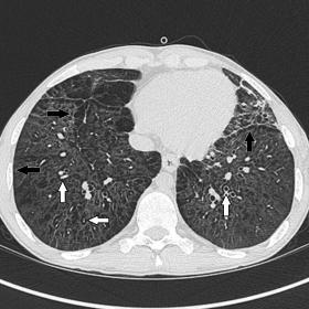 There is extensive pulmonary interstitial emphysema (PIE) in the perifissural and subpleural spaces (black arrows) and in the