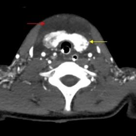 Axial (A) and Coronal (B) CT views revealing an enlarged heterogeneous hyperenhancing thyroid gland (yellow arrow) surrounded