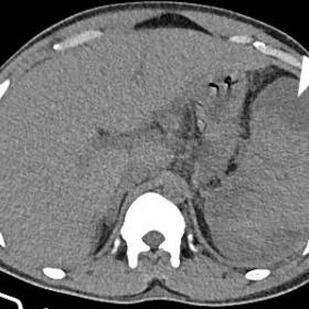 Axial non- contrast enhanced abdominal CT showing enlarged and heterogenous spleen with peri splenic collection (white arrow)