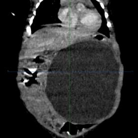 CECT Abdomen (coronal image) showing a large well-defined, thin walled, unilocular, non-enhancing cystic lesion in the left s