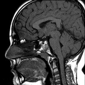 Sagittal and coronal non-contrast T1WI show small sella, hypoplastic anterior pituitary lobe and ectopic neurohypophysis.