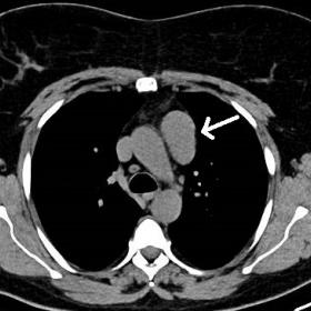 Unenhanced axial thoracic CT showing an  ovoid structure in the left anterior mediastinum (white arrow), with the same densit