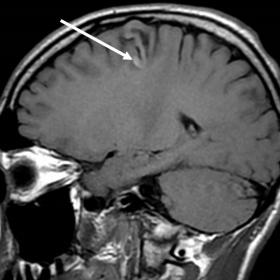 Sagittal T1-weighted image demonstrates a cortico-subcortical right frontal lesion with a subtle T1-hyperintense rim.