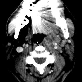 Contrast-enhanced CT, axial, and Fig. 1b sagittal images show peritonsillar fat stranding and a fluid collection with periphe
