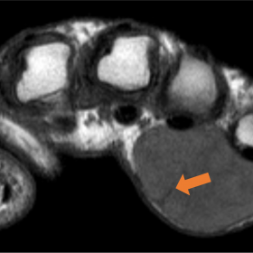 Axial (a) and sagittal (b) T1-WI showing a well-defined encapsulated lesion in the volar aspect of the fourth interdigital sp