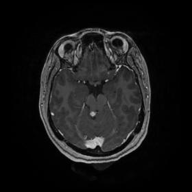 Axial post-contrast T1 image shows a solid-cystic lesion in the anterior aspect of the right cerebellar hemisphere with enhan