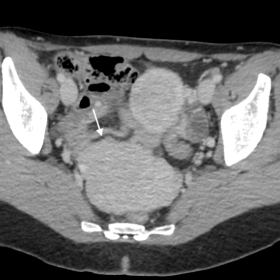 CECT scan on the axial plane showing a well-defined peritoneal mass in the pouch of Douglas (maximum axial diameter of 85 mm)
