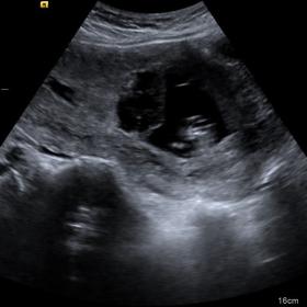Transabdominal Grayscale Ultrasound image on Day 1 shows irregular gestational sac with live embryo in the lower part of uter