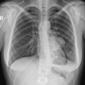 Posteroanterior chest radiograph shows a left perihilar, well-defined, rounded mass. At the left lower base there is an ill-d