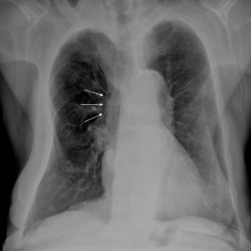 Chest radiograph - PA projection of the chest shows thickening of the right paratracheal stripe (white arrows).