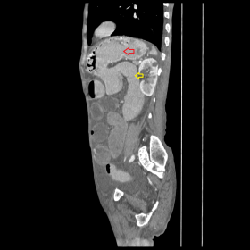 CECT Abdomen (Sagittal reformat) demonstrating side to side gastojejunal anastomosis. (Red arrow: Stomach, Yellow arrow: jeju