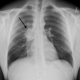 Chest x-ray demonstrates bulky right hilum [thick arrow]. The lungs are clear