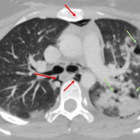 Axial CT image of the lungs, showing diffuse and bilateral consolidations, here more evident on the left side, associated wit