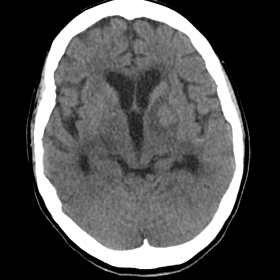 Axial non-contrast CT at the level of the basal ganglia demonstrates a hyperattenuating lesion in the left basal ganglia with