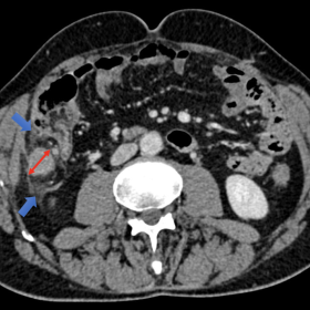 Contrast-enhanced transverse CT scan shows irregular circumferential wall thickening and dilatation of the appendix (red arro