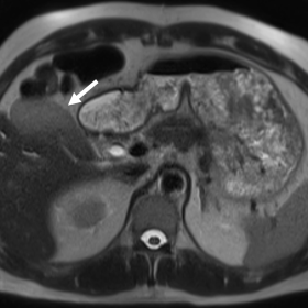 T2-weighted MRI abdomen demonstrates “T2-shading” within the gallbladder consistent with intraluminal hemorrhage