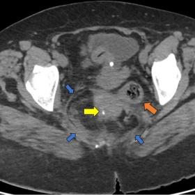 CT images with intravenous contrast, (a) showing a heterogeneous lesion in the retrorectal space (blue arrows show limits of 