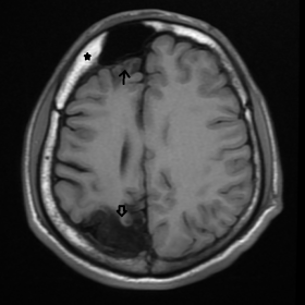 Axial T1 WI showing right cerebral atrophy (arrow up) with prominent right frontal sinus and thickening of bony calvaria on r