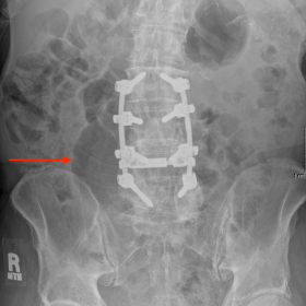 Supine abdominal radiograph demonstrating a single dilated small bowel loop measuring up to 5.4 cm in the mid abdomen (red ar