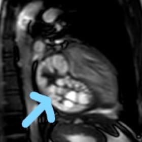 Steady-state free-precision VLA cine demonstrating the presence of a multi-loculated cystic mass in the basal to mid inferolateral LV wall