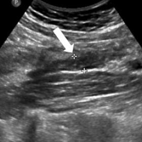 : Ultrasound longitudinal plane at the right flank demonstrates an enlarged noncompressible tubular structure with hypoechoic