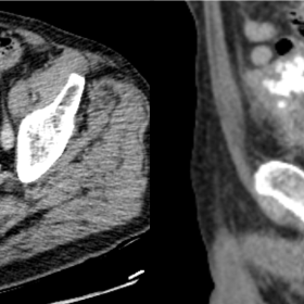 Axial (A) and sagittal (B) contrast-enhanced CT images in the portal venous phase show a large exophytic soft tissue mass wit