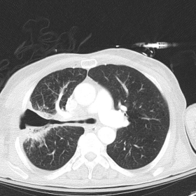 Enhanced axial CT image demonstrating a bronchopleural fistula