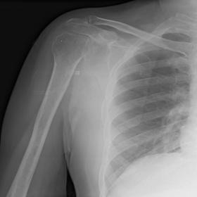 Conventional radiograph of AP view right shoulder shows a solitary expansile radiolucent lytic lesion in the bony glenoid of 