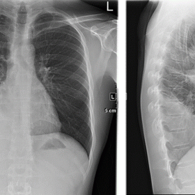 Chest X-ray (PA and LL) showed opacification of the lower right hemithorax, with a pleural effusion component