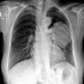 Chest radiography showing a well-defined large lesion in the middle third of the left lung