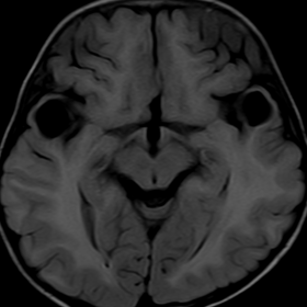 Axial T1 weighted MRI image at the midbrain level showing two hypointense cystic lesions in the anterior segment of bilateral