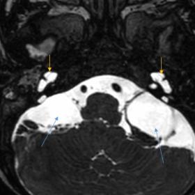 Axial CISS image showing bilateral cystic cochlea (yellow arrows) with absent modiolus and arachnoid cysts along bilateral ce