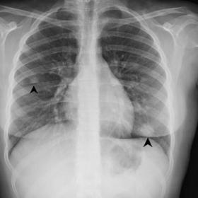 A chest radiograph on the first admission showed a consolidation on the inferior third of the left lung and two nodular opaci