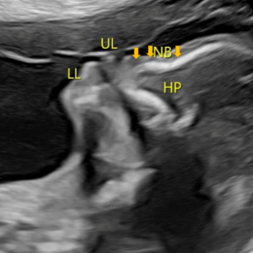Sagittal 2D ultrasound of the fetal profile: Flattening of maxilla with verticalized hypoplastic nasal bone (UL: Upper Lip, L