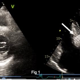 Transthoracic echocardiography revealed localised dense calcification (white arrows) in the basal portion of interventricular