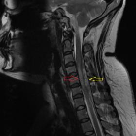 T2-weighted sagittal (A) and axial (B) images of cervical spine show posterior epidural collection (yellow arrow) appearing p