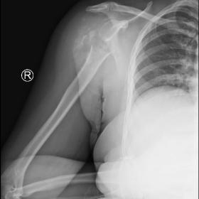 Radiograph in flexion shows destruction of the right proximal humeral head, neck, and body with soft tissue swelling