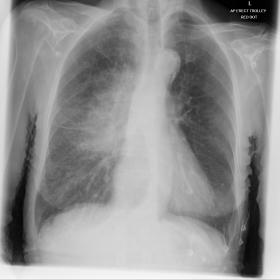 This anterio-posterior chest radiograph shows evidence of consolidation in the right peri-hilar region and changes consistent