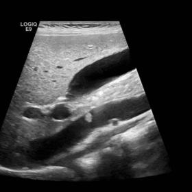 Ultrasound of the abdomen (A) with colour-doppler (B) showed a round shape filling defect in the suprarenal tract of the infe