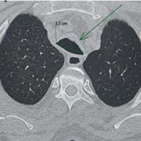 Selected axial CT image showing widened and flattened tracheal lumen