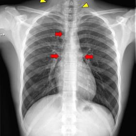 Chest x-ray on PA view (a) shows linear lucencies along pulmonary hila and paratracheal regions (red arrows) with subcutaneou