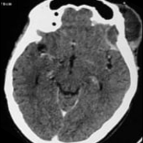 Axial Contrast enhanced CT showing peripherally enhancing subgaleal and epidural collection