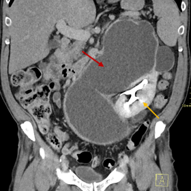 The upper pole moiety ureter (red arrow) is severely dilated and follow its tortuous course in the pelvis. The yellow arrow i