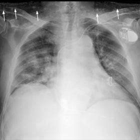 Chest radiography (a) showing multiple diffuse small subcutaneous calcifications. In an oblique rib projection (b) the presen