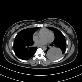 A chest CT scan revealed a large round lesion, approximately 6 cm in diameter, in the lower lobe of the left lung, with a wel