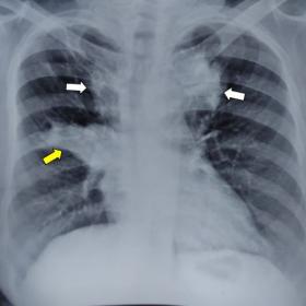 Ill-defined non-homogenous radio opacities in bilateral upper zones (white arrows) involving paratracheal regions with the me